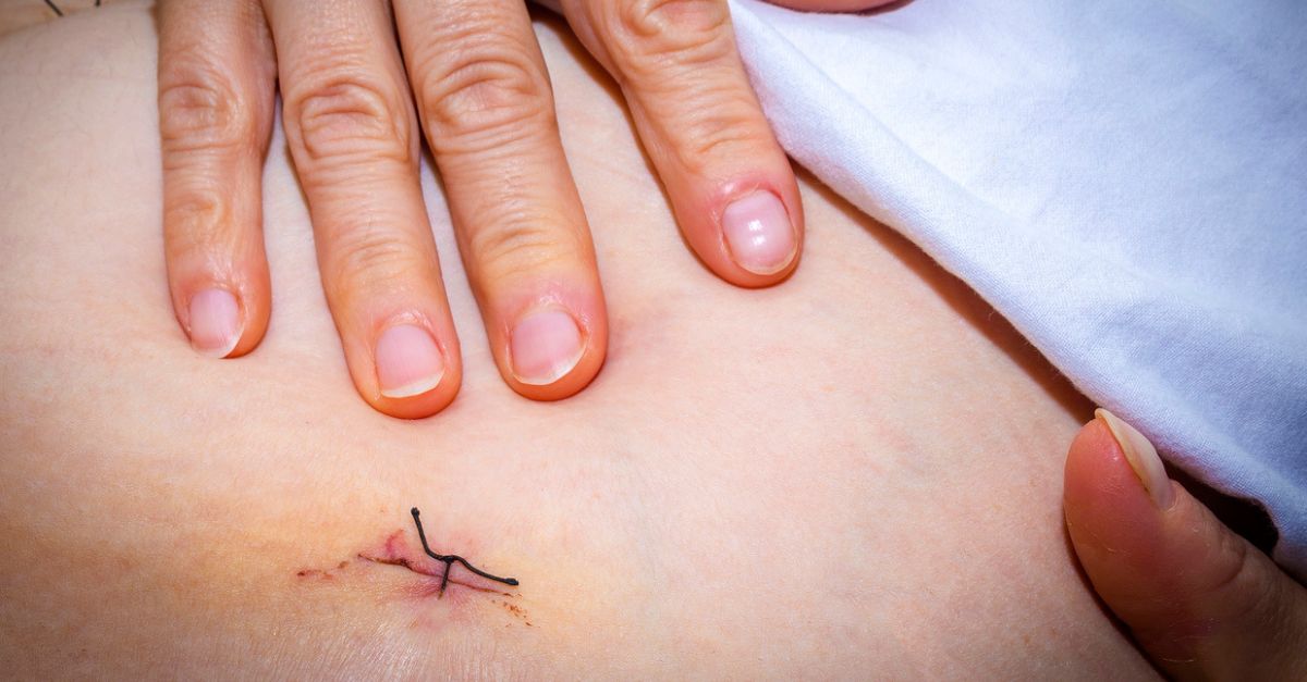 Women holding abdomen with stitches from laparoscopic endometriosis surgery